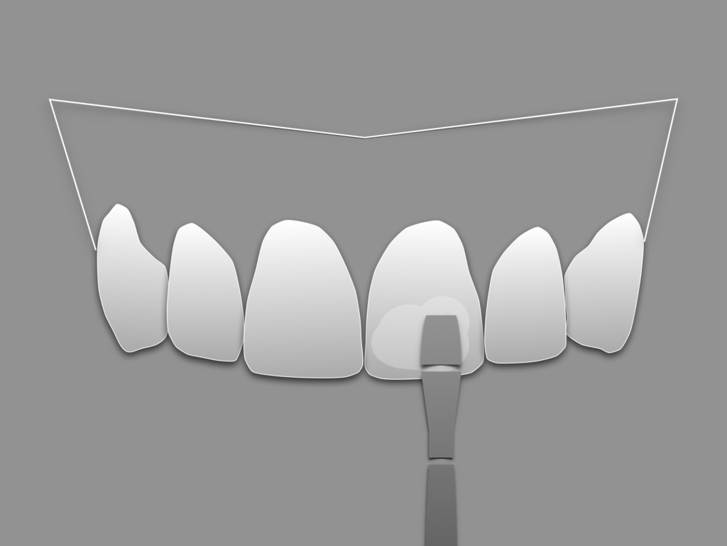 Carillas de composite - Smile design