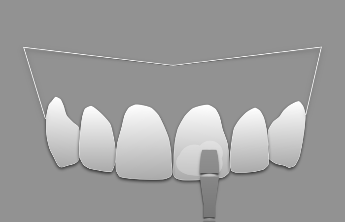 Carillas de composite - Smile design