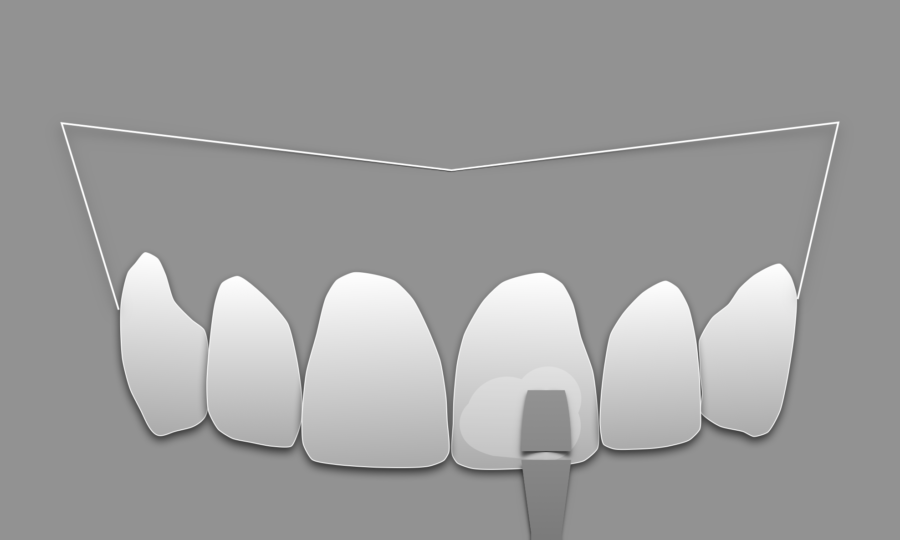 Carillas de composite - Smile design