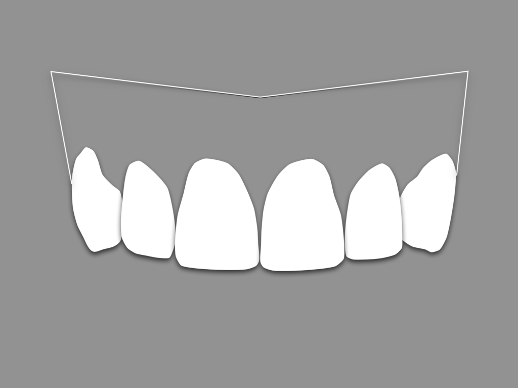 Blanqueamiento dental