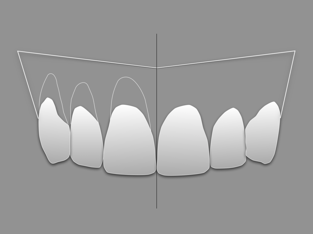 Cirugía plástica periodontal