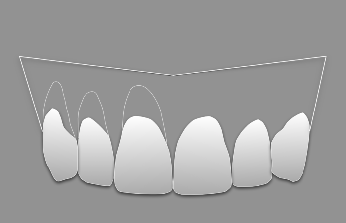 Cirugía plástica periodontal