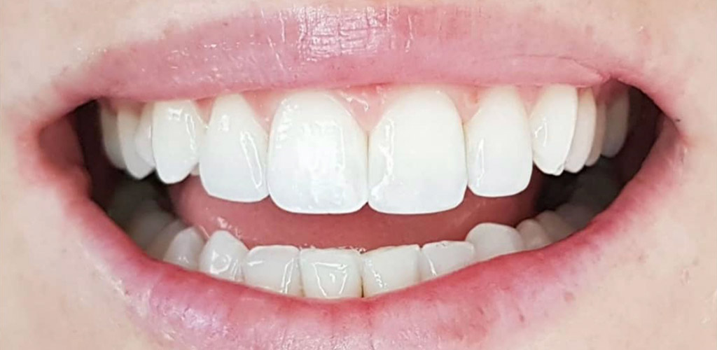Carillas de Composite - Clínica Dental Bustamante