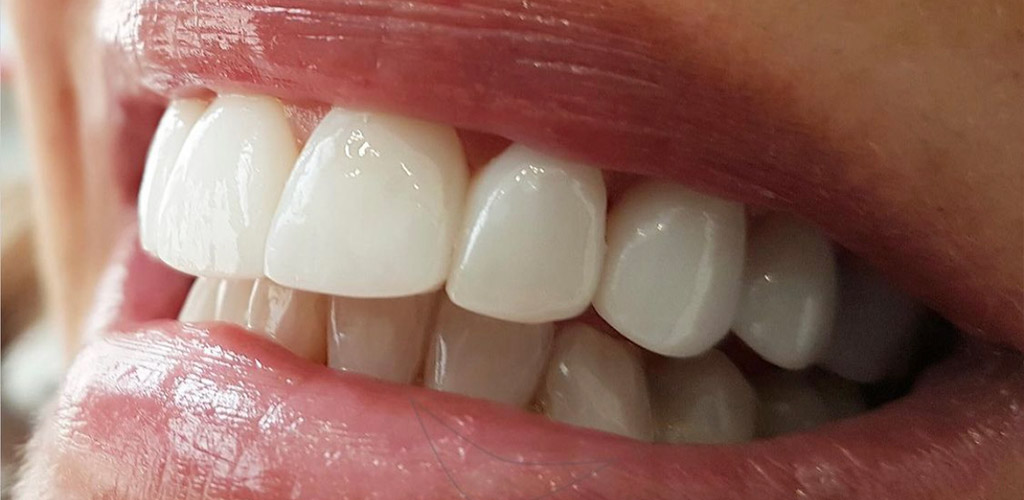 Carillas de Porcelana - Clínica Dental Bustamante Carillas de Porcelana - Clínica Dental Bustamante