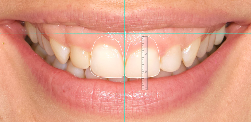 Cirugía Plástica Periodontal - Clínica Dental Bustamante