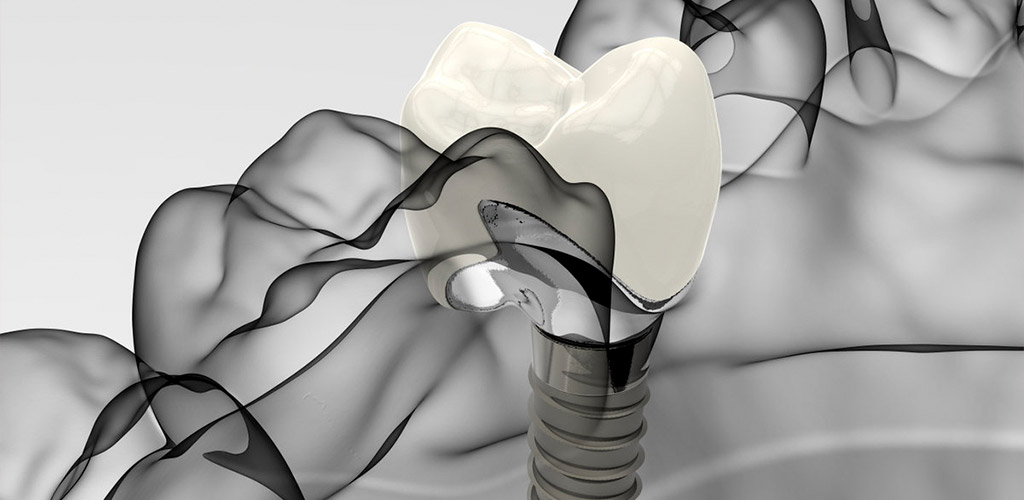 Implantología - Clínica Dental Bustamante