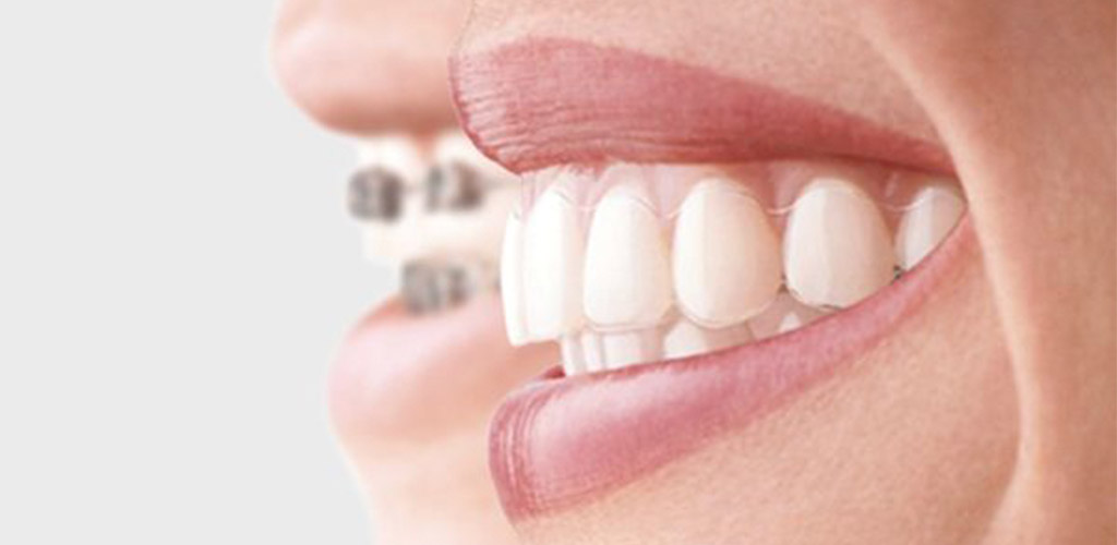 Ortodoncia - Clínica Dental Bustamante