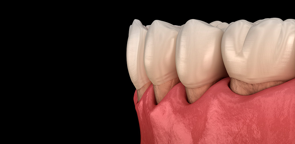 Periodoncia - Clínica Dental Bustamante