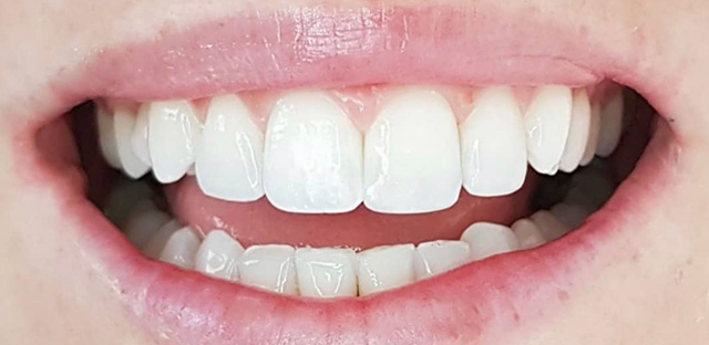 Carillas de composite - Clínica Dental Bustamante