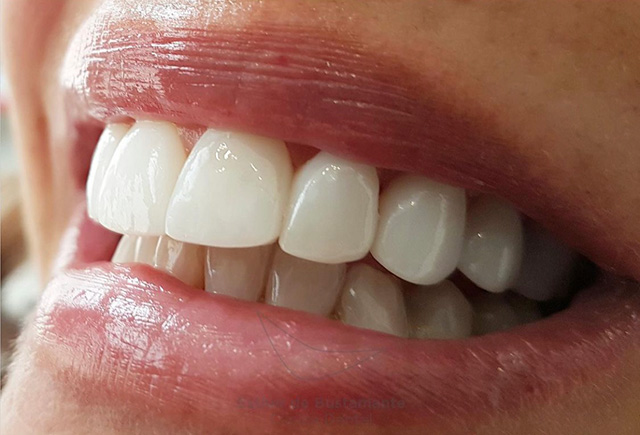 Carillas de porcelana - Clínica Dental Bustamante