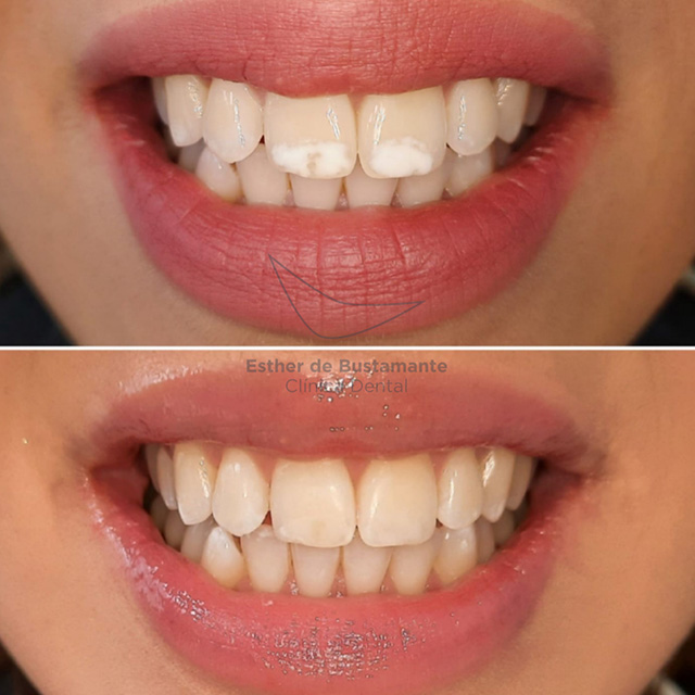 Eliminación Manchas Blancas - Clínica Dental Bustamante