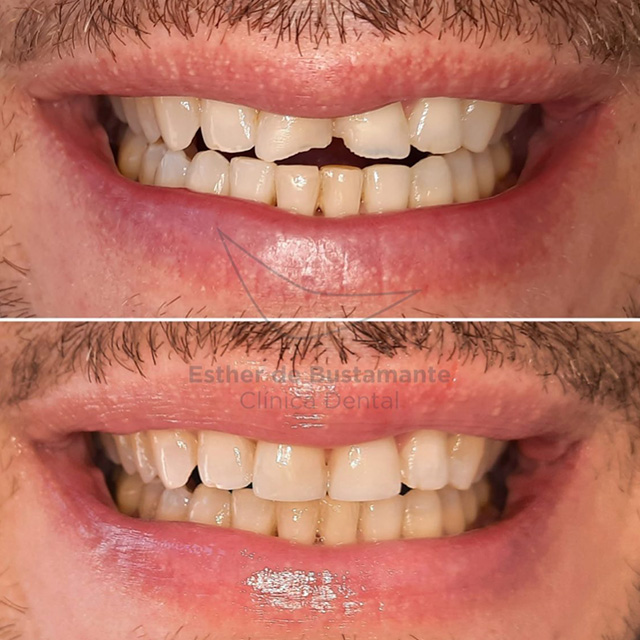 Fracturas Dentales - Clínica Dental Bustamante